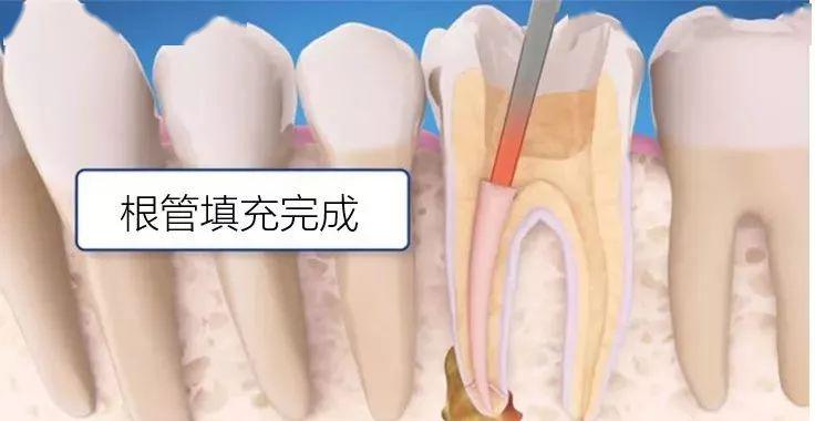 根管填充根管治疗可能会涉及多次复诊,有些牙根有炎症或者瘘管的牙齿