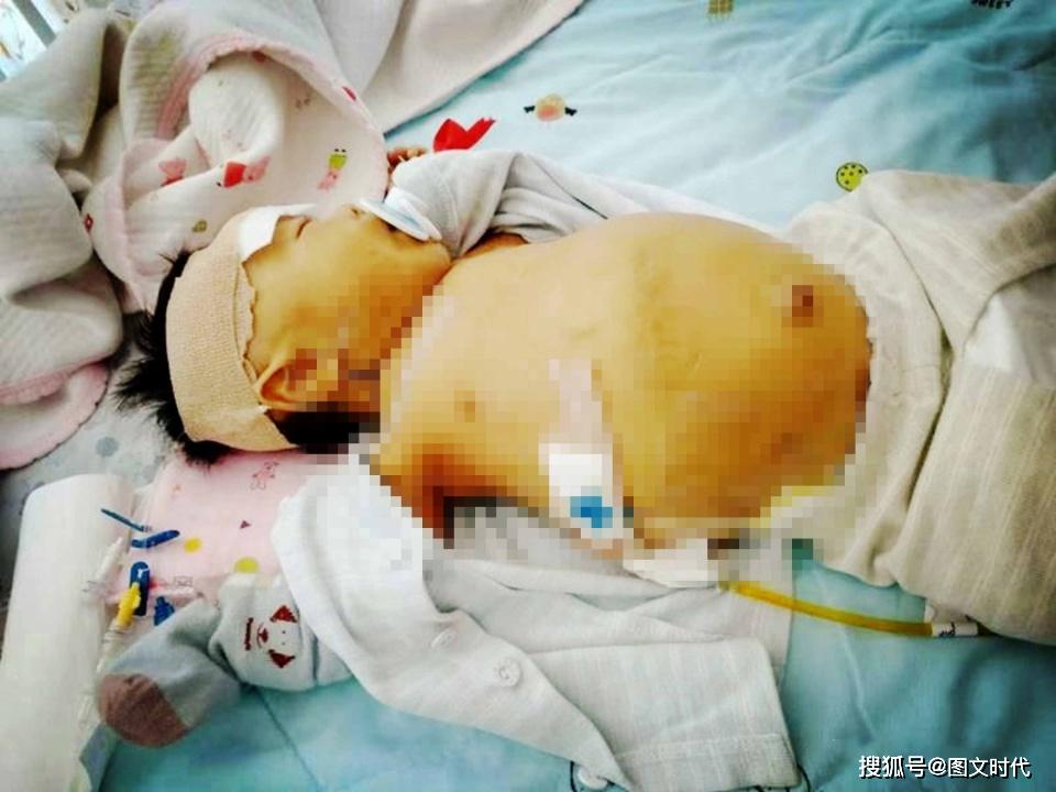 「奶奶」奶奶狠心赶病孙离家后，她自己也哭了男婴肝移植后又患癫痫