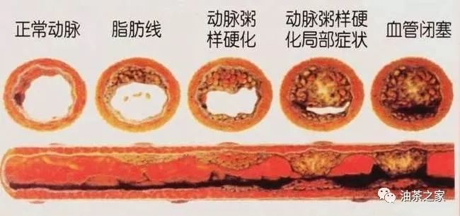 茶油真的能预防或缓解动脉粥样硬化斑块吗