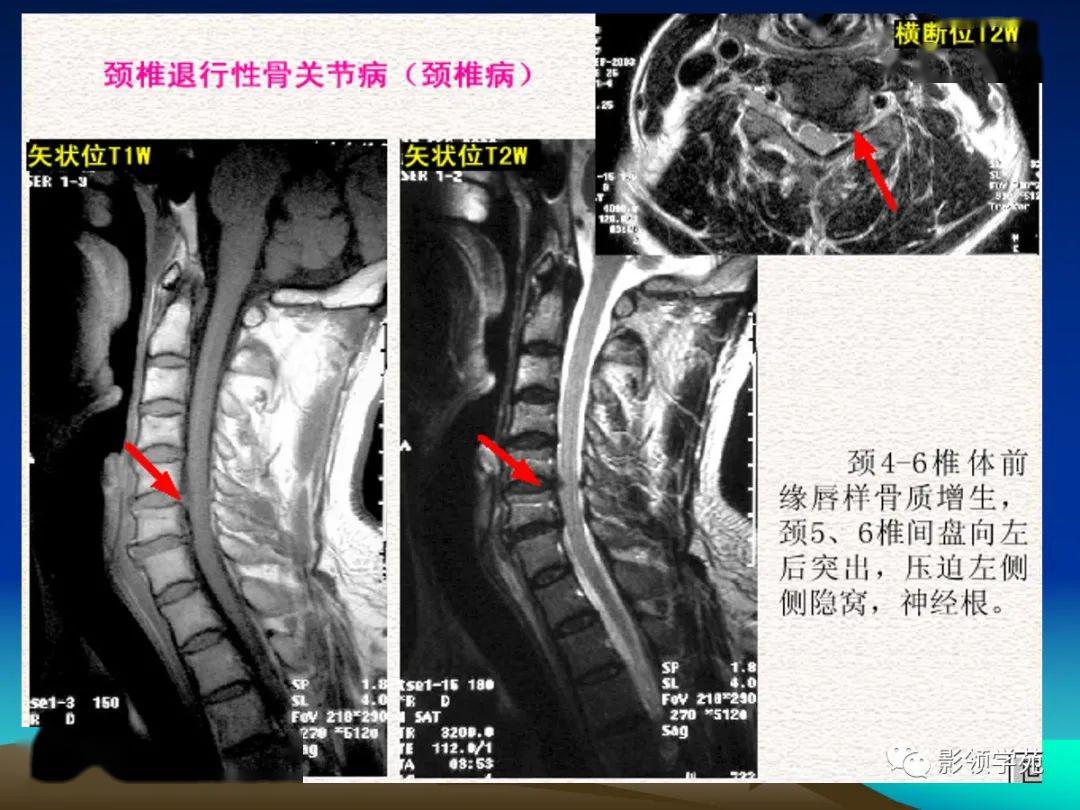 颈椎精细解剖及相关疾病影像表现