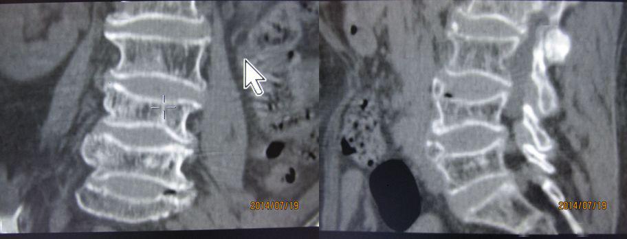 收藏贴 | 颈椎,腰椎ct常见病变,你都了解吗?