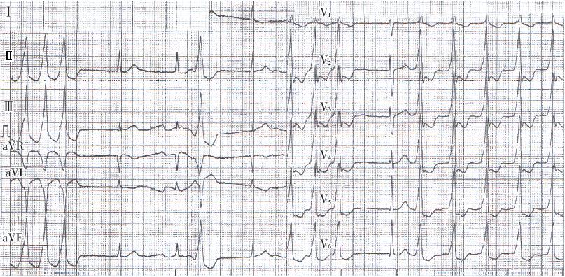 1例特殊房颤患者的心电图特征附心电专栏合辑