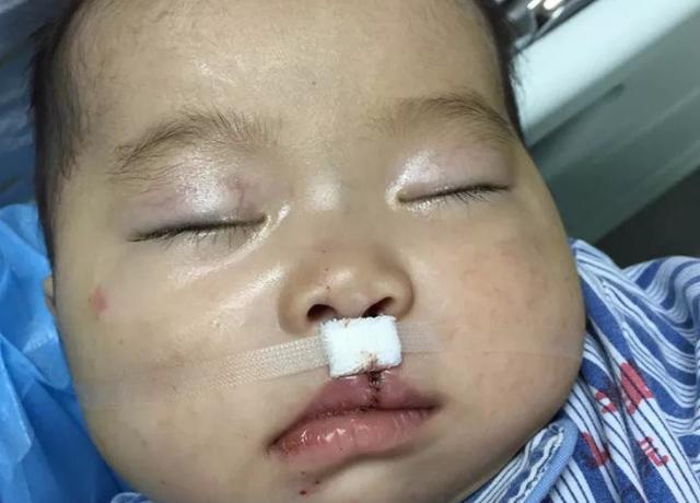 唇腭裂人口_唇腭裂图片(3)