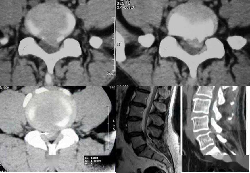 收藏贴 | 颈椎,腰椎ct常见病变,你都了解吗?