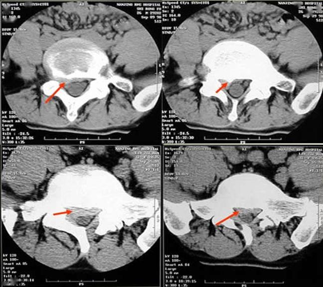 收藏贴 | 颈椎,腰椎ct常见病变,你都了解吗?