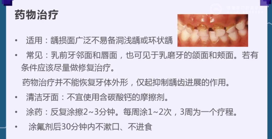 该患者左下第一前磨牙的所见就是特纳牙的临床