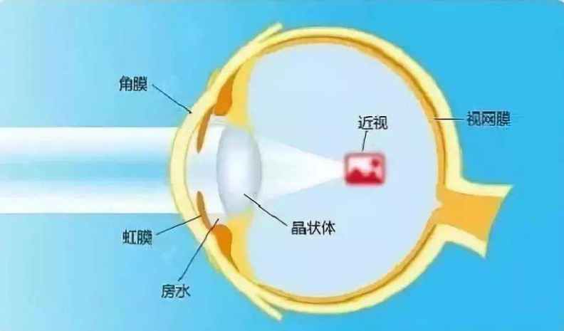 近视矫正手术的原理_从原理讲透彻 东莞全飞秒近视手术的利与弊