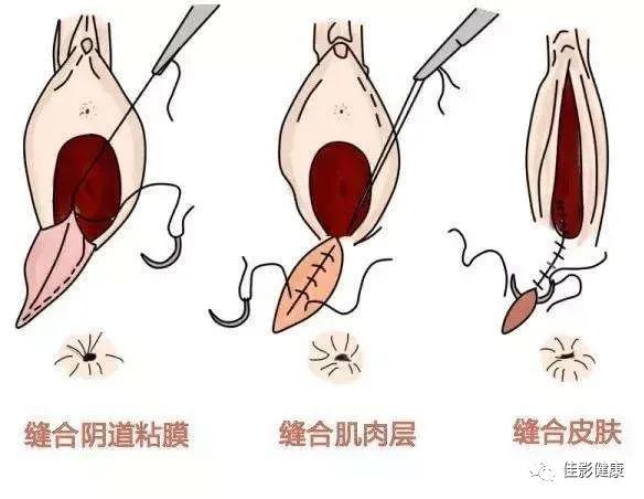 顺产侧切这一刀,躲得过吗?