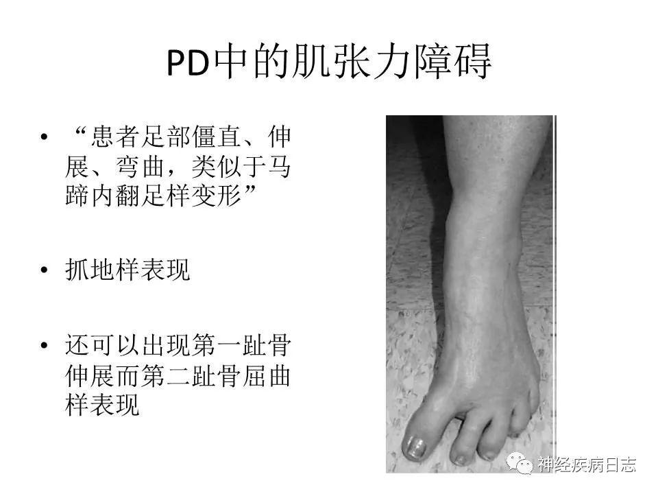 帕金森病中的肌张力障碍