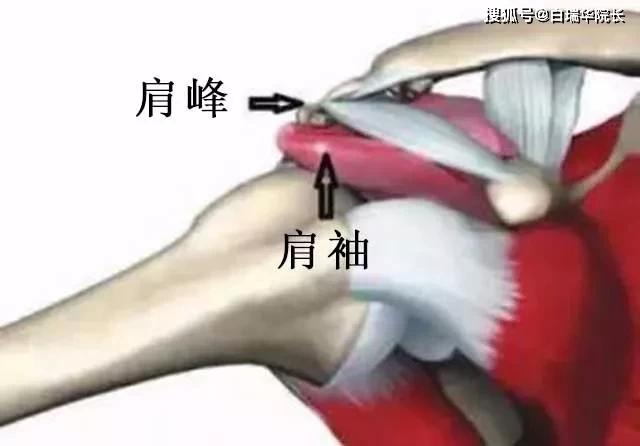肩膀痛,最可能的原因是什么?