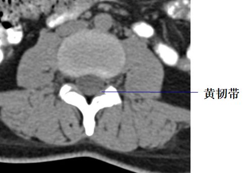黄韧带较厚(正常时≤3mm,位于椎板和关节突的内侧面,密度高于硬脊膜