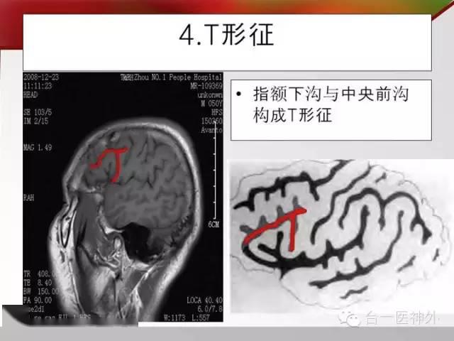 头颅mri矢状面脑沟回七大征象