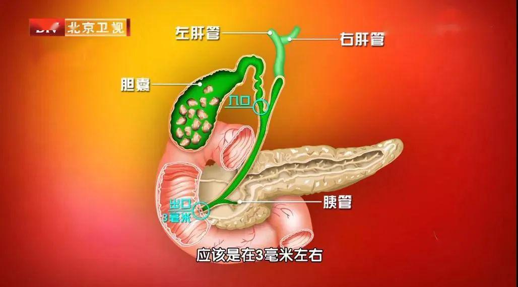 胆管同时也是胰液输出的通道,一旦被胆结石堵塞就可能导致胰液反流