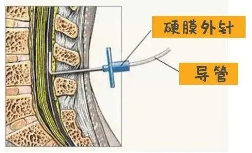 椎管内分娩镇痛是一种椎管内阻滞麻醉镇痛法,原理是通过硬膜外腔阻断