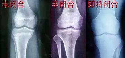 黄金@这5个坑别再踩了10岁女孩比同学矮半头:5月长高黄金期