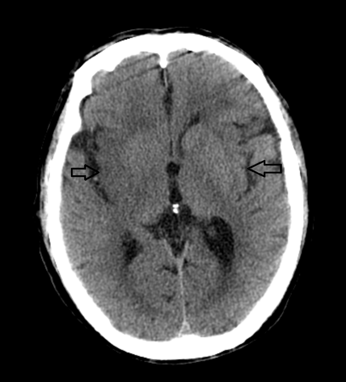 超急性期大面积脑梗死 ct 平扫表现