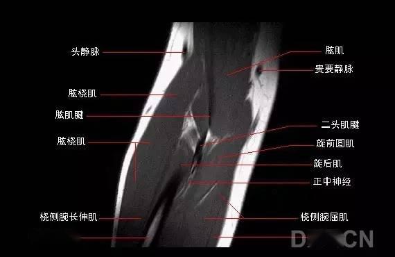 影像解剖 | 肘关节mri图谱超全整理