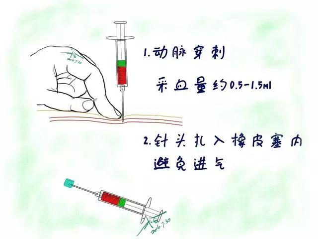 第一步:采样 现在一般都是直接用 bd 的血气针,穿刺桡动脉或股动脉