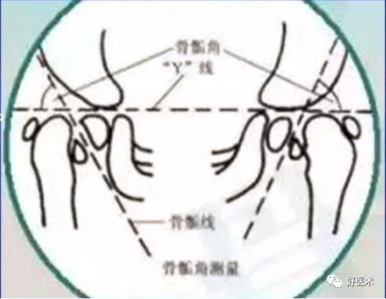 收藏| 骨科常用的角度测量方法汇总,全在这里了!