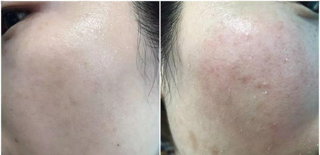 但是  用磨砂颗粒的右脸,几乎没有角质出来,而且皮肤还被搓红了,同事