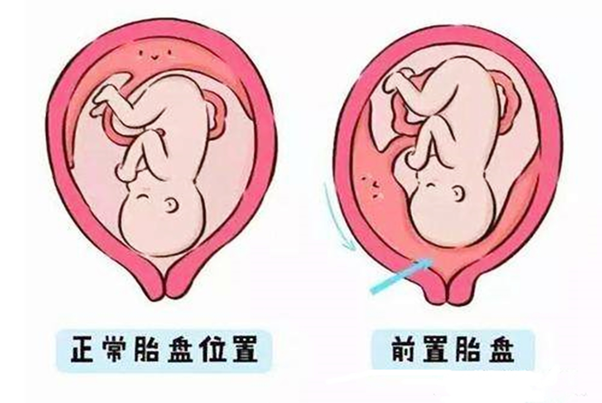 原创胎盘前壁前置还傻傻分不清其实区别很大对宝宝影响也不一样