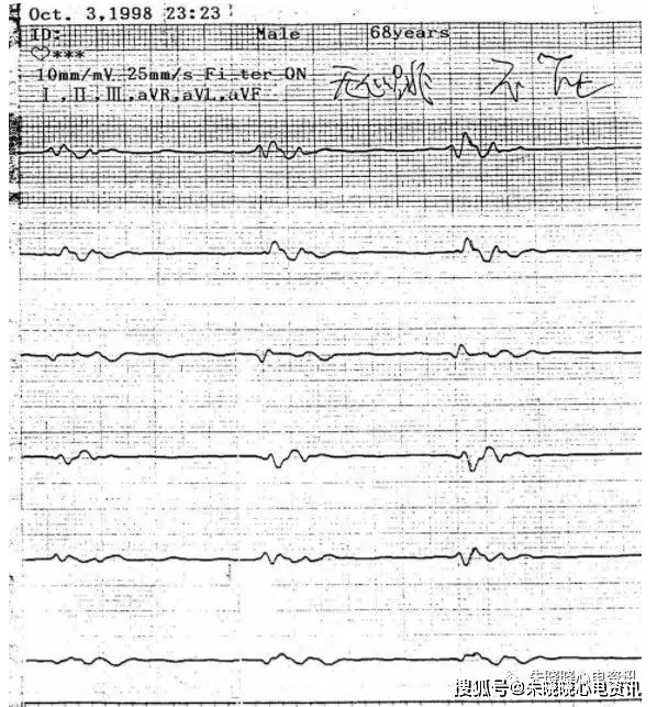 多份临终心电图波形_人体