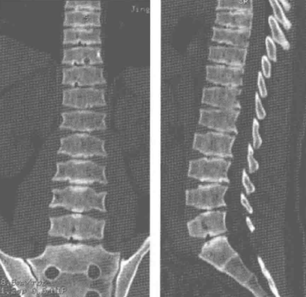 mri表现除显示 上述形态改变外,椎体中后部上下缘呈驼峰状突起,脊椎