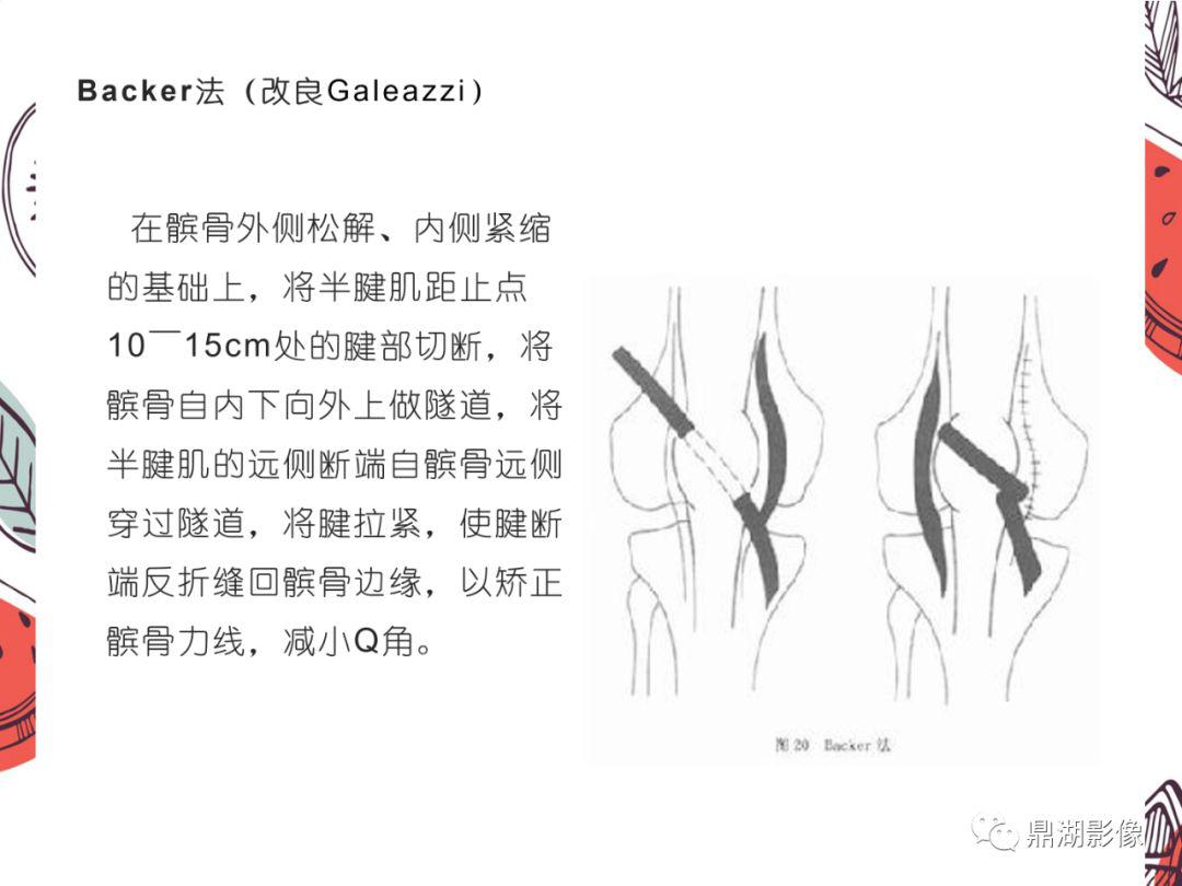 髌骨不稳定髌骨失稳