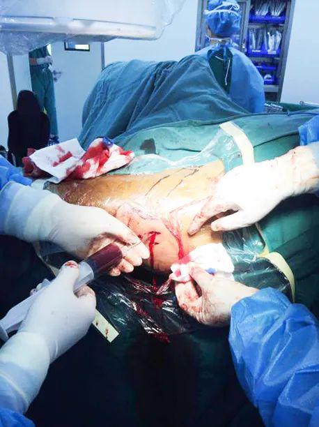 在髂骨上穿刺抽取骨髓血后,股骨颈关节囊穿刺减压,注入骨髓血进行移植
