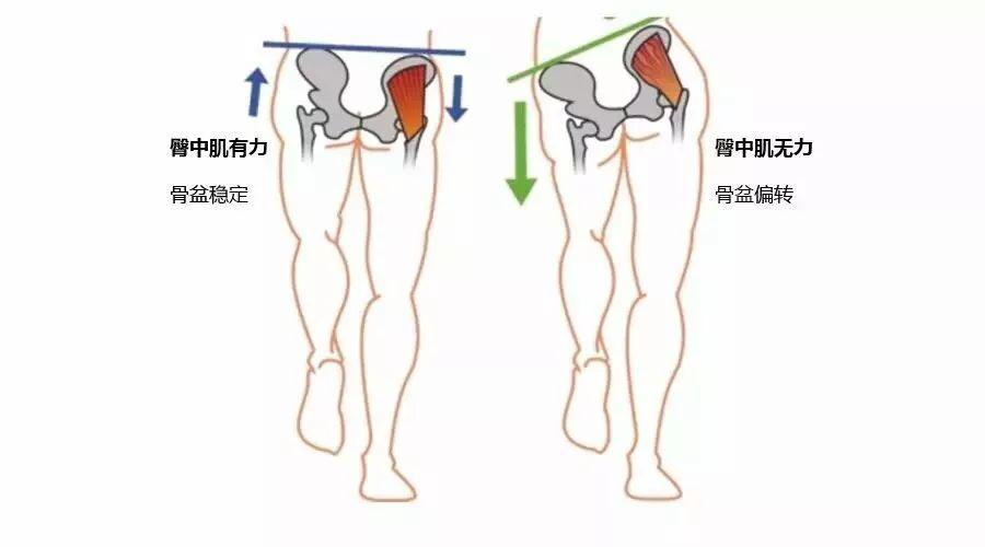 1. 股骨过度内收和内旋