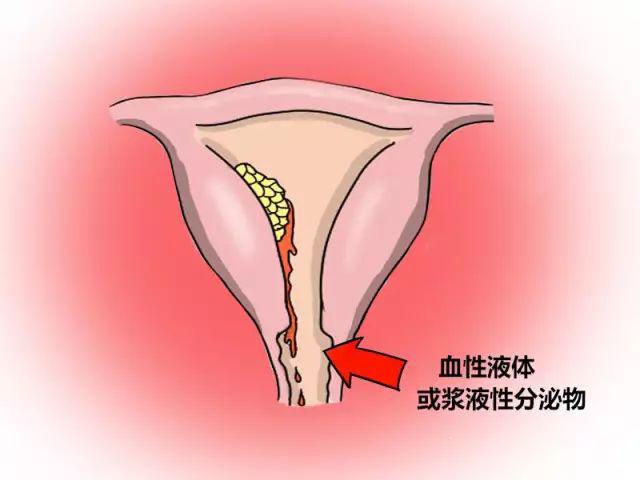 内膜病灶表面有渗出或继发性感染,阴道会有血性液体或浆液性分泌物,常