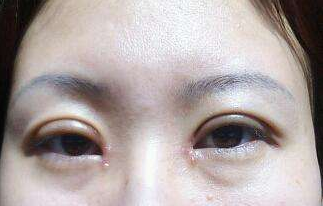 北京华韩:开眼角之后疤痕的增生期有多久后会消失?