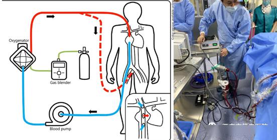 仁医新术心内科完成市级医院首例ecmo支持下复杂高危冠脉介入手术
