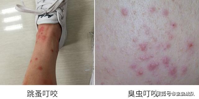 家里没发现虫子,怎么才能确定是被什么害虫咬了?