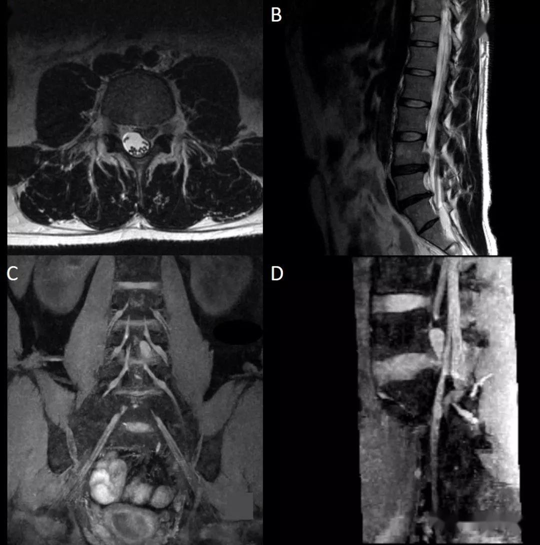 腰骶丛磁共振神经成像(mr neurography of the lumbosacral plexus)