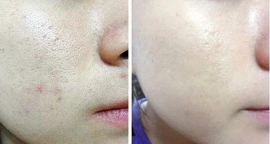 毛孔粗大、皮肤粗糙？这些医美手段赶快安排起来~