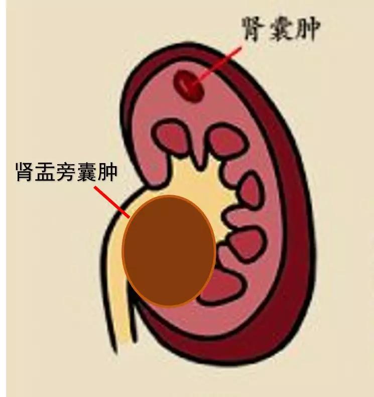 67肾镜和输尿管软镜的妙用治疗肾囊肿