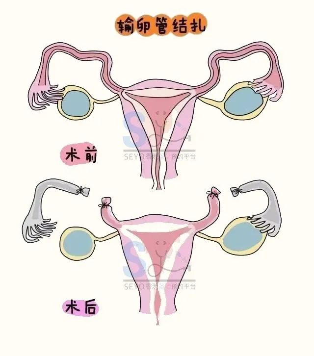 男性结扎的原理_男性结扎原理:切断输精管