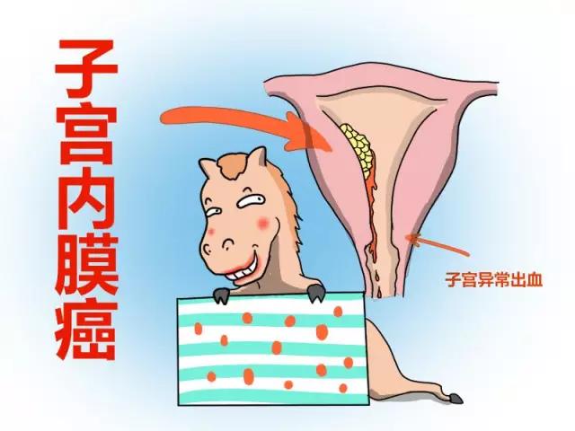 子宫内膜癌你了解多少?