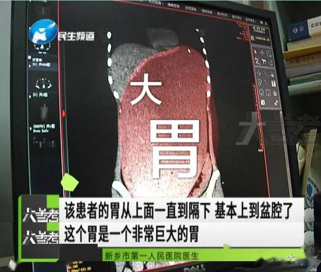 减肥后一顿饭,差点被撑死!医生:从没见过这么大的胃