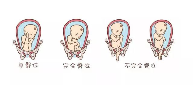 普通的宝宝出生时是头先出,再来才是身体,而臀位宝宝则是臀部朝下,也