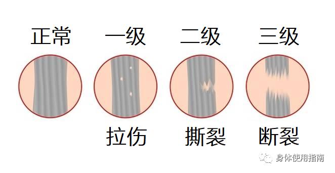 肌肉拉伤丨身体使用指南