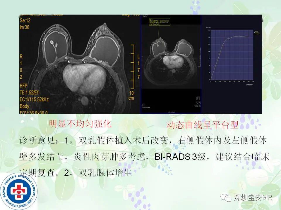 乳腺磁共振扫描