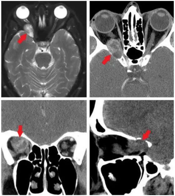 眼眶核磁和ct检查可见眶内肿瘤(红箭头所示为肿瘤)
