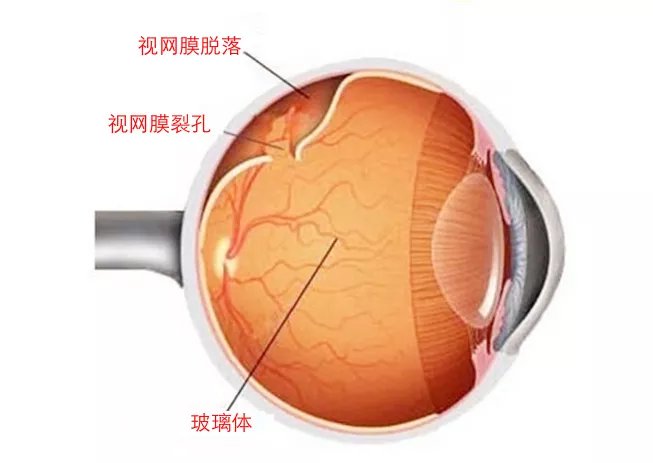 什么是高度近视眼底 6ea8034827864ae4b7c79504e8d92ed0.jpeg