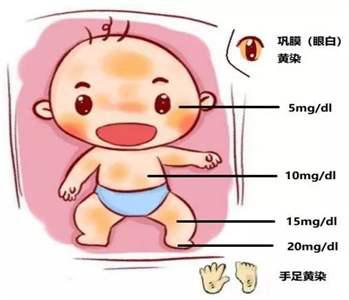 一医青年专家说科普⑩丨护士长冯小芳新生儿黄疸究竟是不是病真相是