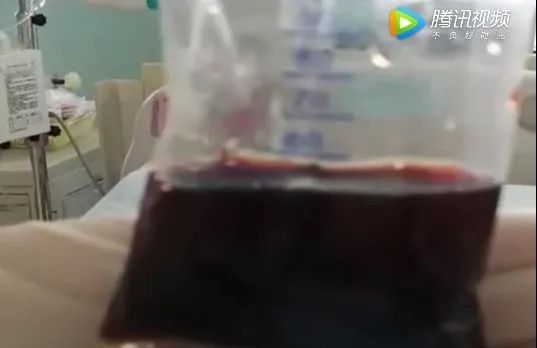 [家家]男孩拉出“酱油尿”住进ICU,就因吃了它！几乎家家餐桌上都有