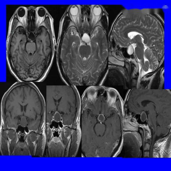 鞍区病变影像诊断上