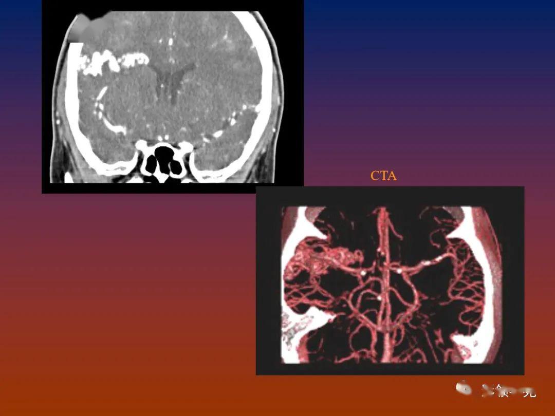 脑血管畸形影像学诊断