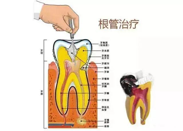 "根管治疗"就是"抽牙神经"吗?_牙齿